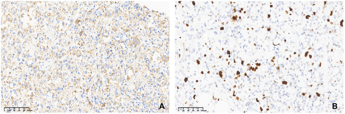 Immunohistochemical analysis of histiocytic sarcoma. (A) Neoplastic cells positive for CD68 (IHC×200), (B) Ki-67 labeling index was about 30% (IHC×200).
