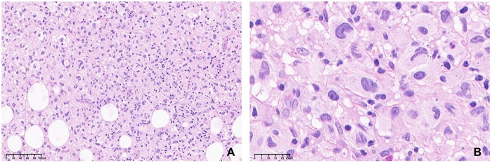 Pathology from the initial biopsy. The lesion consisted of large neoplastic cells with abundant eosinophilic cytoplasm, eccentrically placed nuclei, and increased mitotic activity. (A) H&E stain (X200), (B) H&E stain (X800).