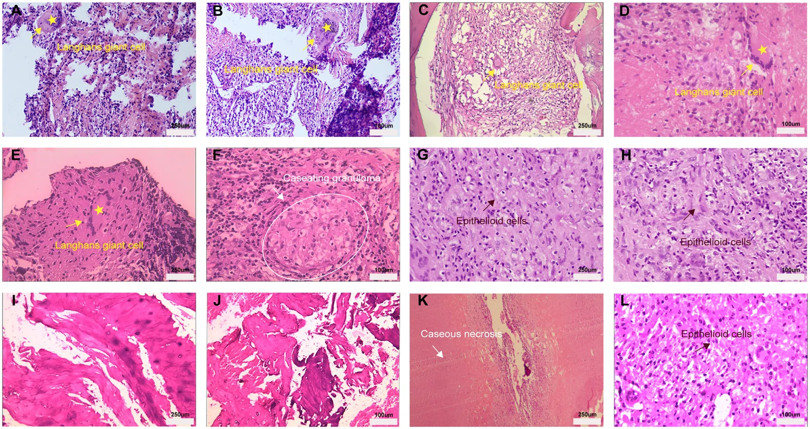 Representative H&E histopathology of spinal tuberculosis lesions showing recurrent pathological patterns. Yellow arrows and asterisks: multinucleated Langhans-type giant cells. White arrows and circles: caseous granulomas. Brown-red arrows: epithelioid cells. Human tissue.