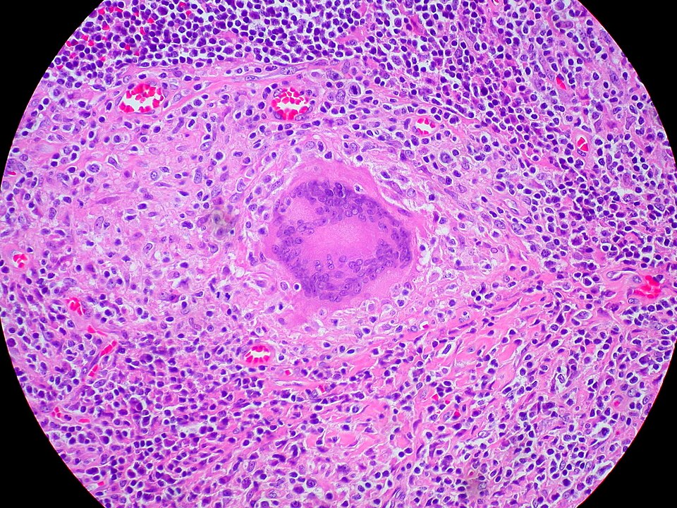 Langhans giant cell in a caseating tuberculous granuloma. Haematoxylin and eosin. Human tissue. The peripheral arrangement of nuclei is characteristic of Langhans type, distinguishing it from the scattered nuclei of foreign-body giant cells.